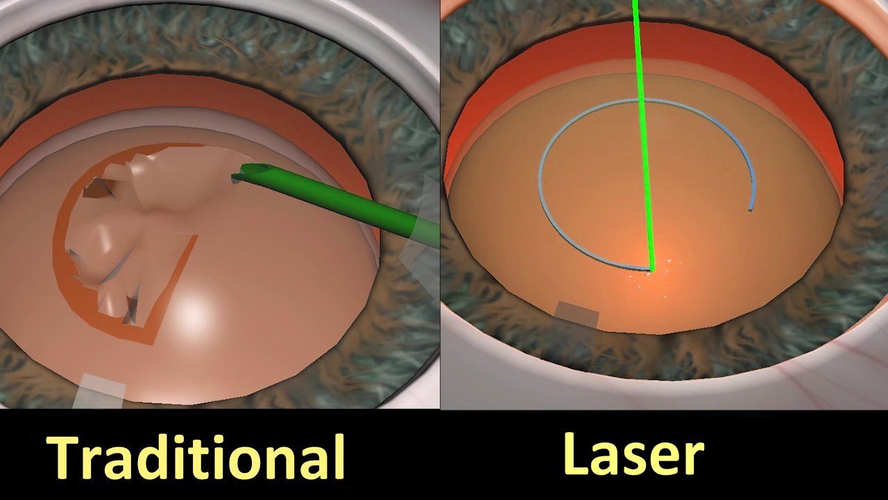 Benefits of Laser Cataract Surgery in 2023